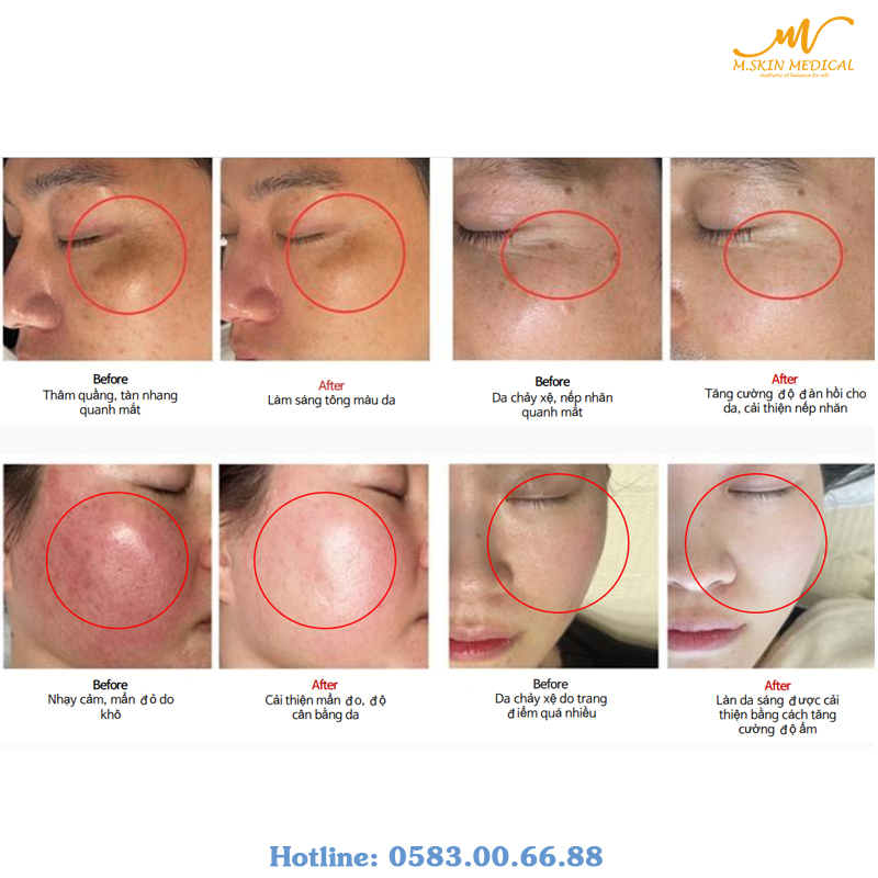 Trước và sau của PDX5 Skin Booster Complex