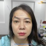 nâng cung mày bằng chỉ Foxeye